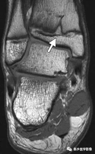 详细的骨骺正常发育和常见骨骺疾病的MRI成像