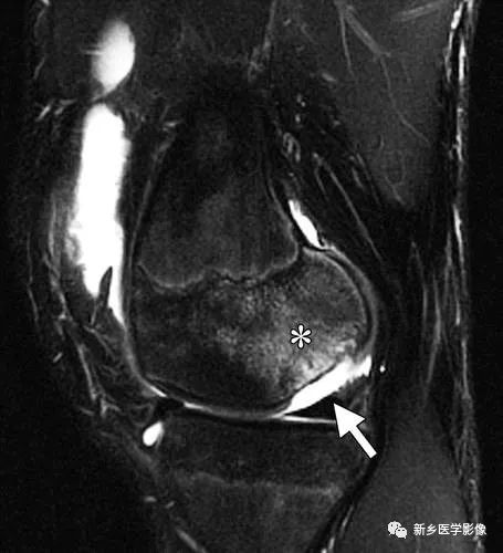详细的骨骺正常发育和常见骨骺疾病的MRI成像
