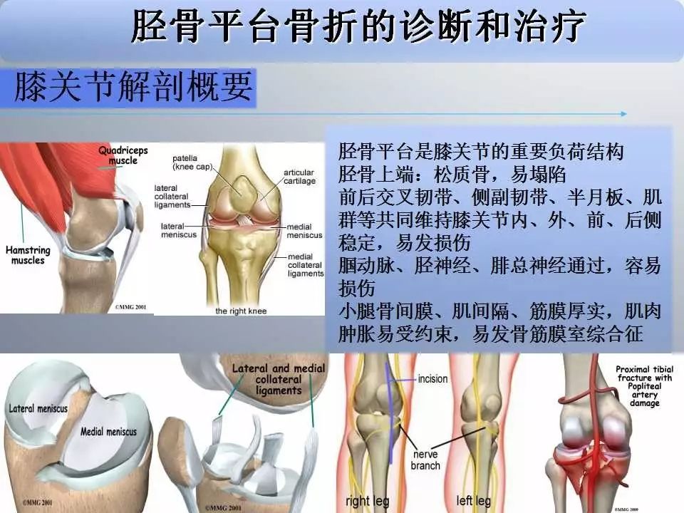 一篇掌握：胫骨平台骨折的诊断与治疗技巧