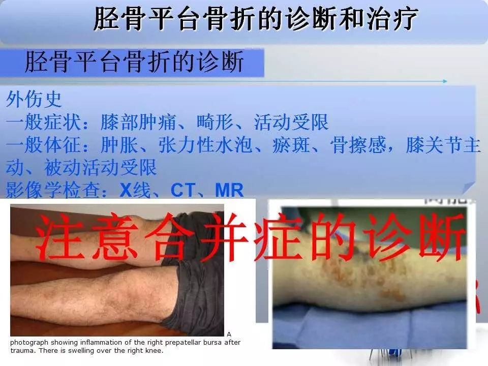 一篇掌握：胫骨平台骨折的诊断与治疗技巧