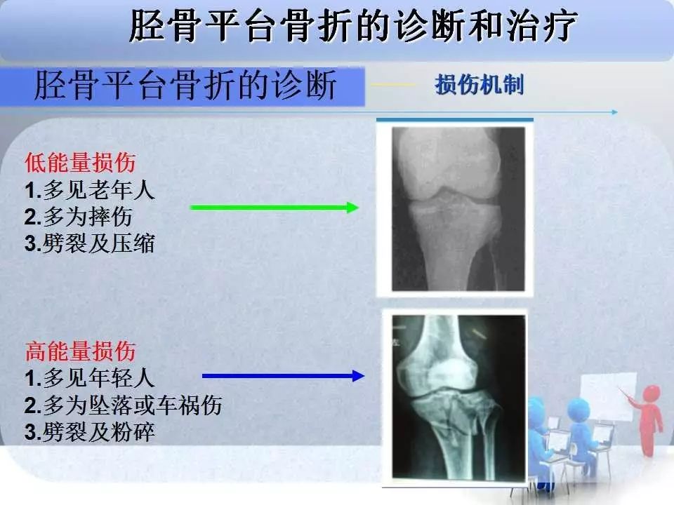 一篇掌握：胫骨平台骨折的诊断与治疗技巧