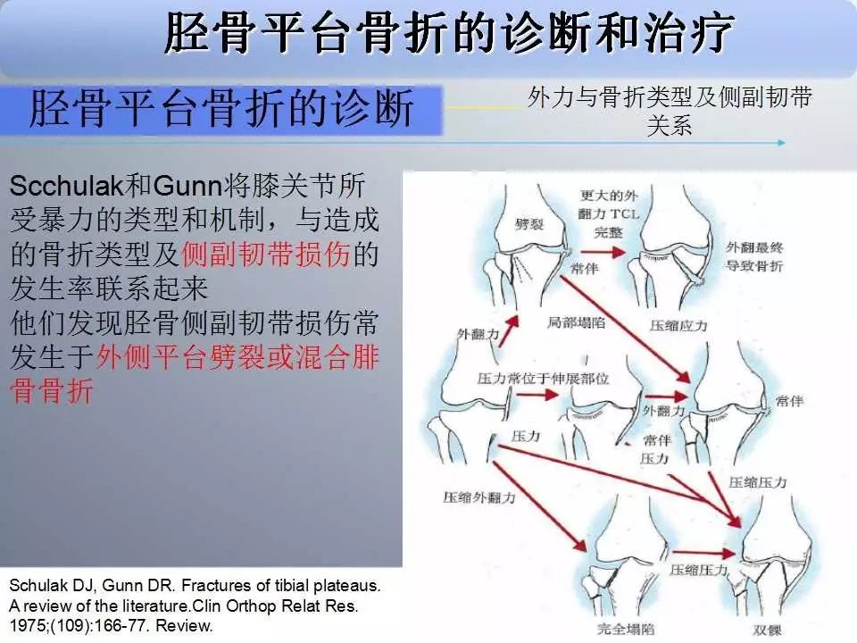 一篇掌握：胫骨平台骨折的诊断与治疗技巧