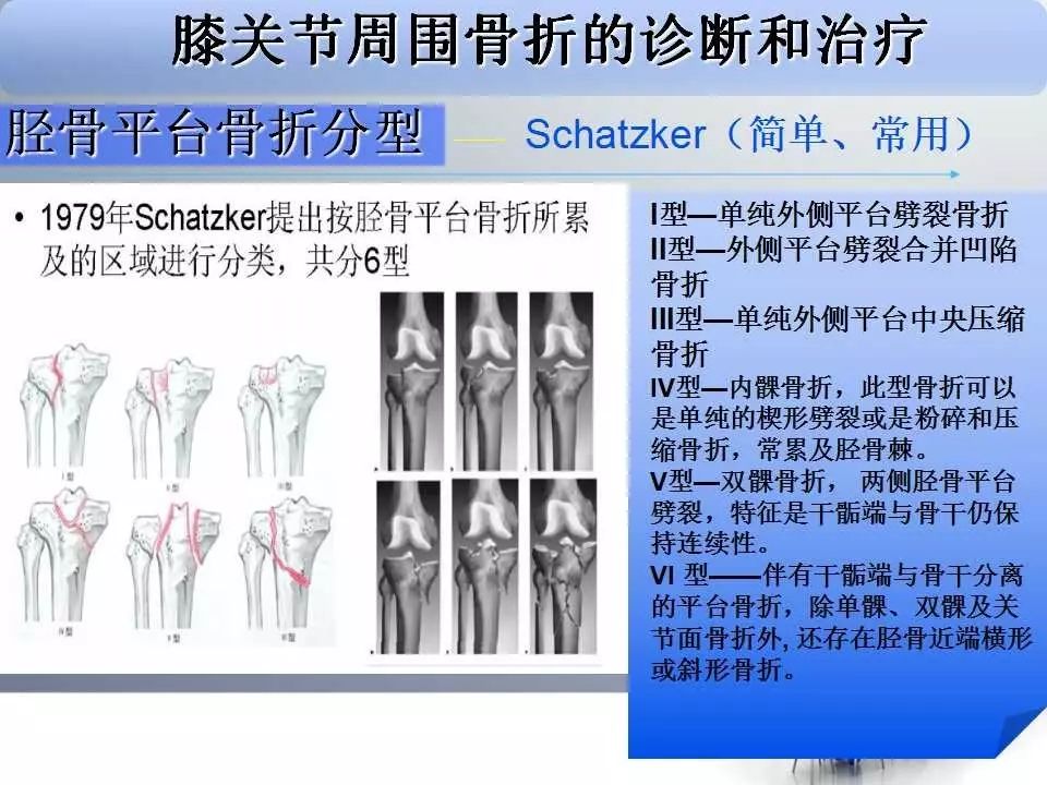一篇掌握：胫骨平台骨折的诊断与治疗技巧