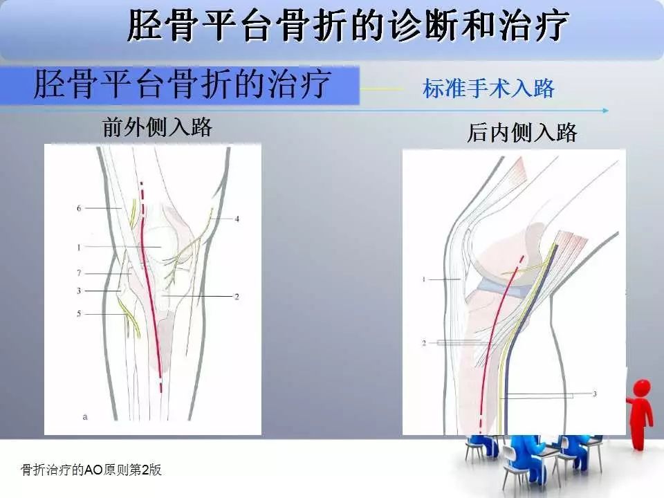 一篇掌握：胫骨平台骨折的诊断与治疗技巧