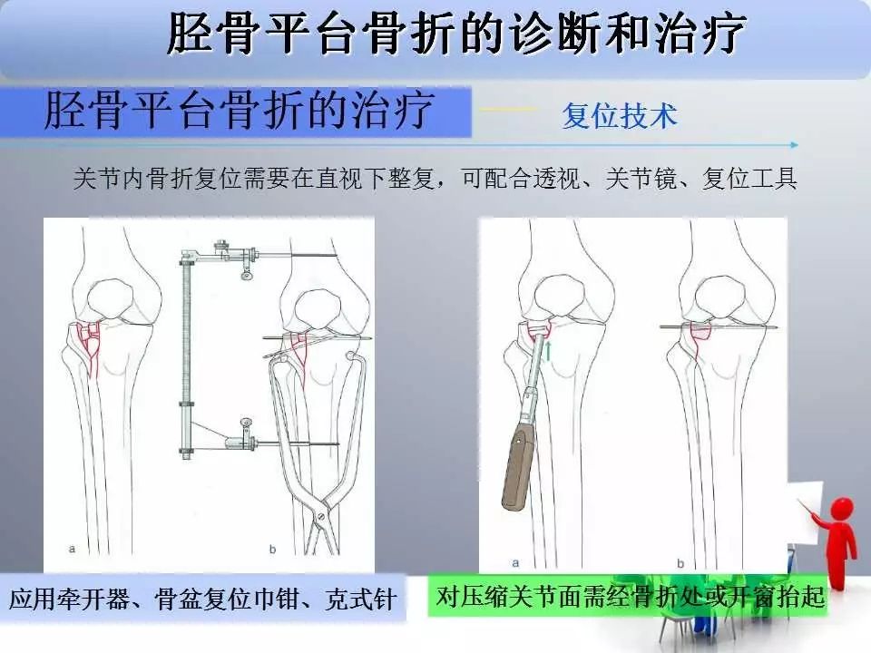 一篇掌握：胫骨平台骨折的诊断与治疗技巧