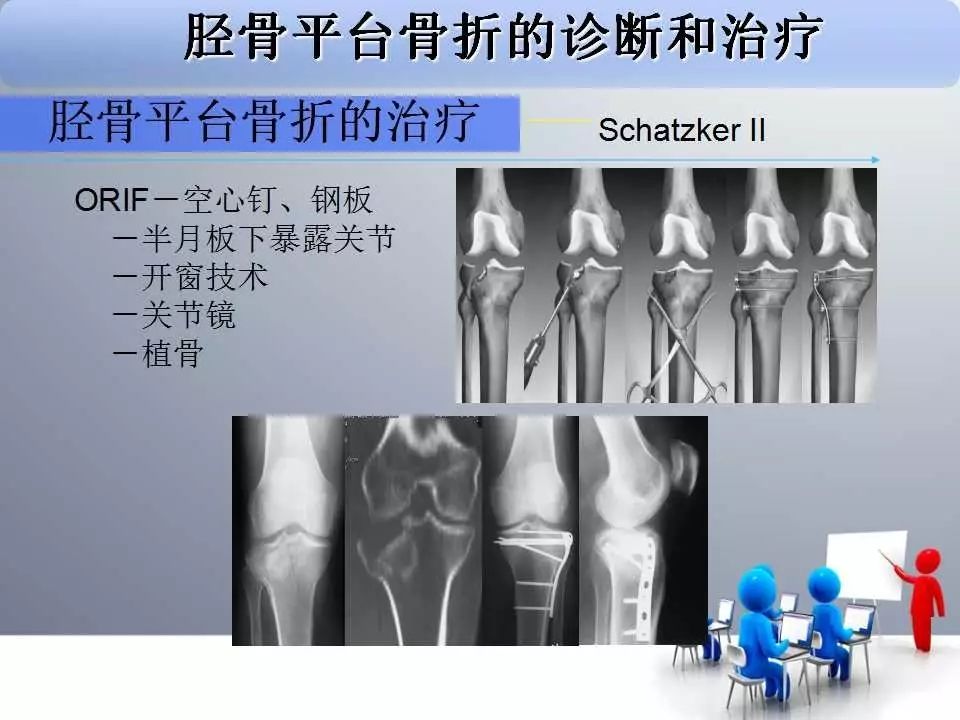 一篇掌握：胫骨平台骨折的诊断与治疗技巧