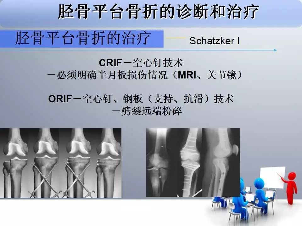 一篇掌握：胫骨平台骨折的诊断与治疗技巧