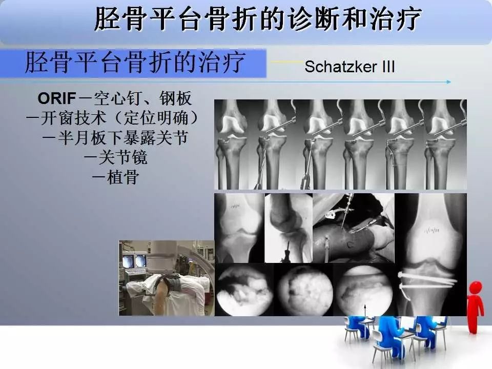 一篇掌握：胫骨平台骨折的诊断与治疗技巧