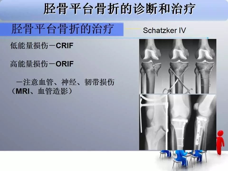 一篇掌握：胫骨平台骨折的诊断与治疗技巧