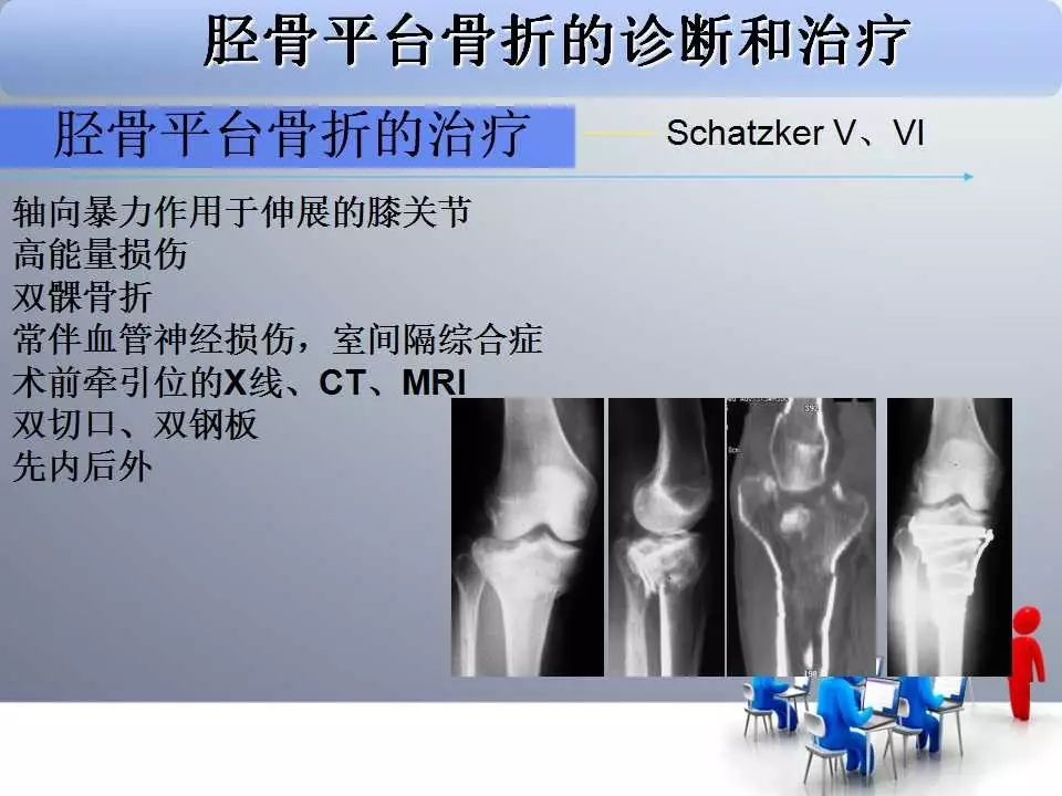 一篇掌握：胫骨平台骨折的诊断与治疗技巧