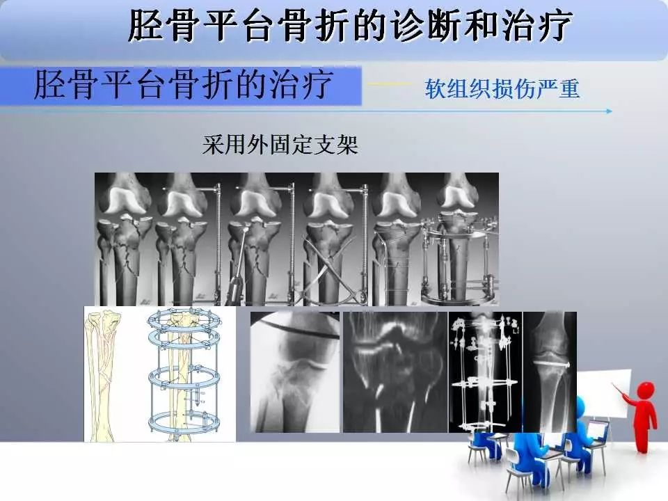 一篇掌握：胫骨平台骨折的诊断与治疗技巧