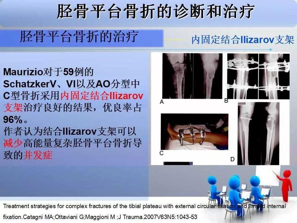一篇掌握：胫骨平台骨折的诊断与治疗技巧