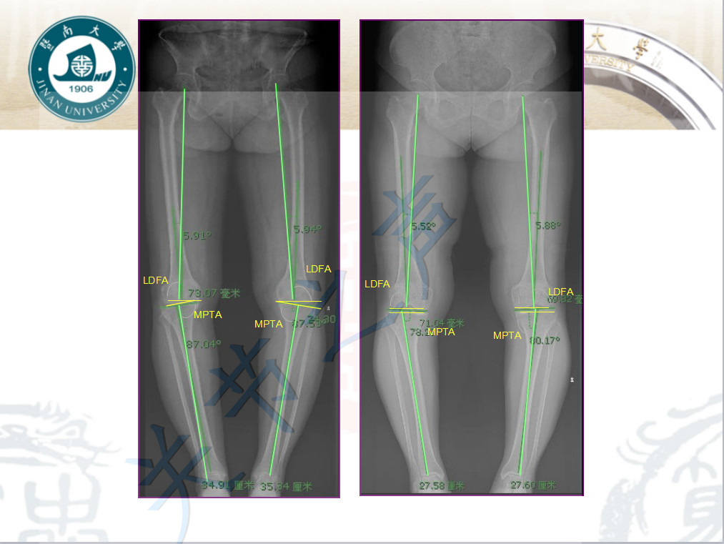 人工全膝关节置换术、单髁置换术、胫骨高位截骨术如何选择
