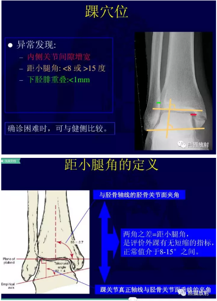 一篇掌握：踝关节的韧带解剖及损伤表现