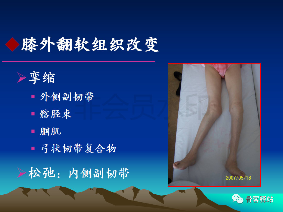 膝关节外翻畸形及不稳的临床处理