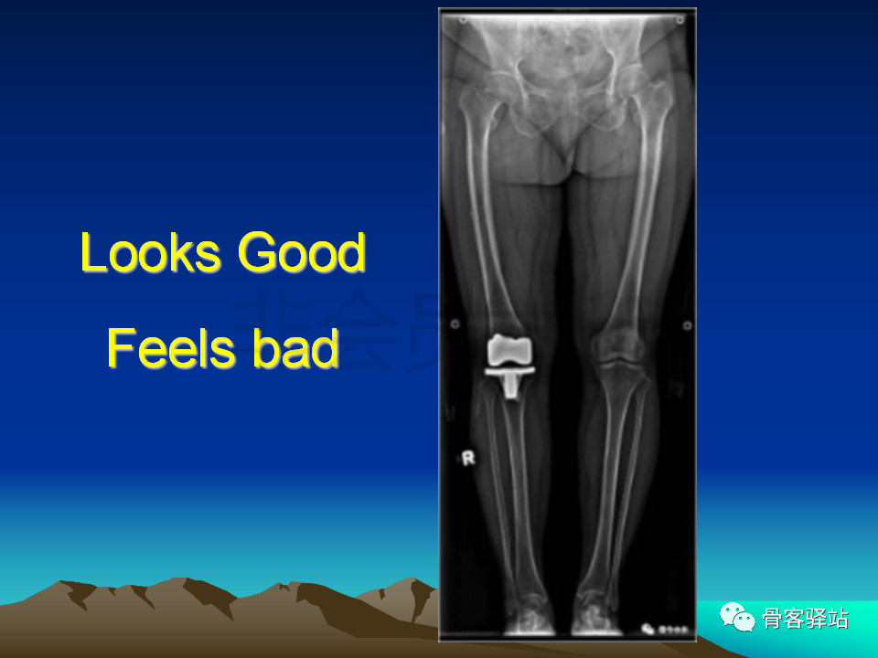 膝关节外翻畸形及不稳的临床处理