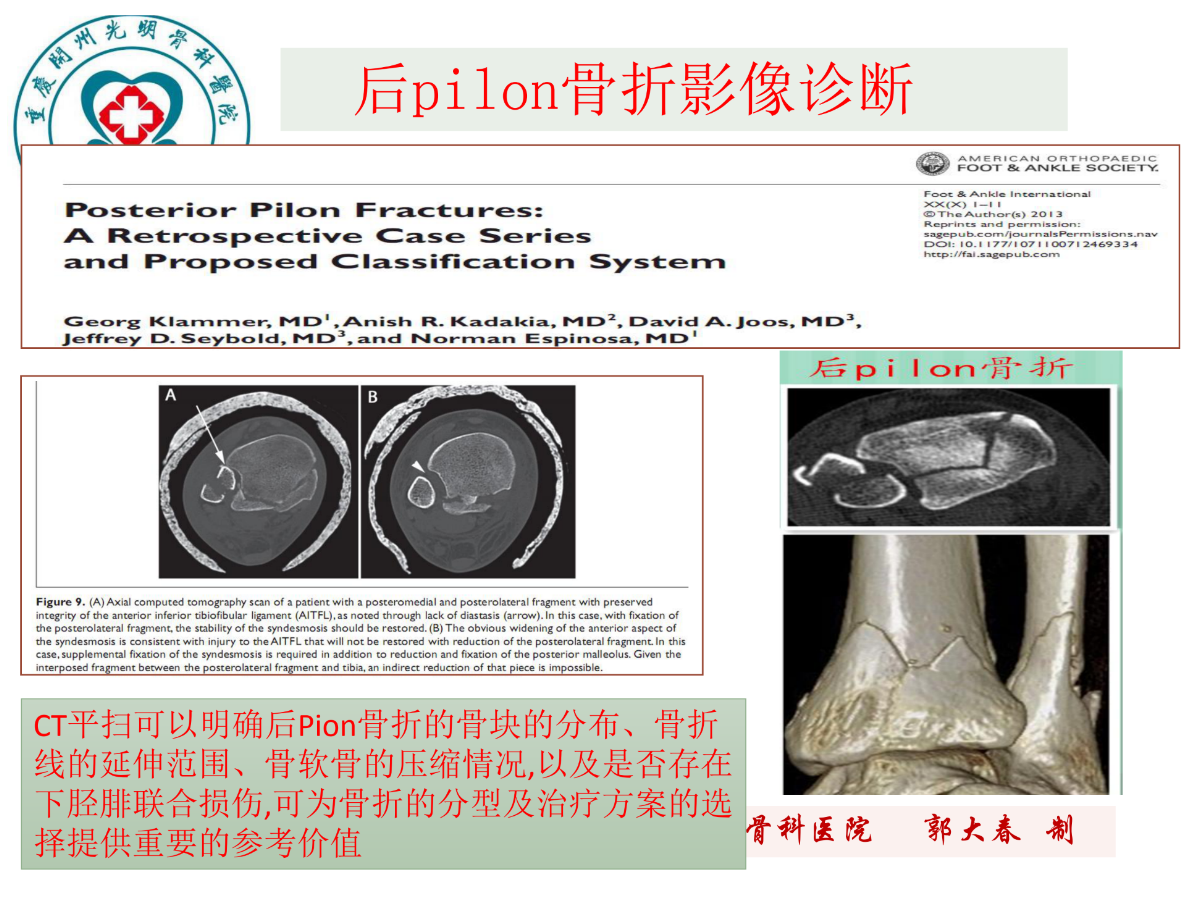 关于后pilon骨折的治疗策略，看这篇就够了！