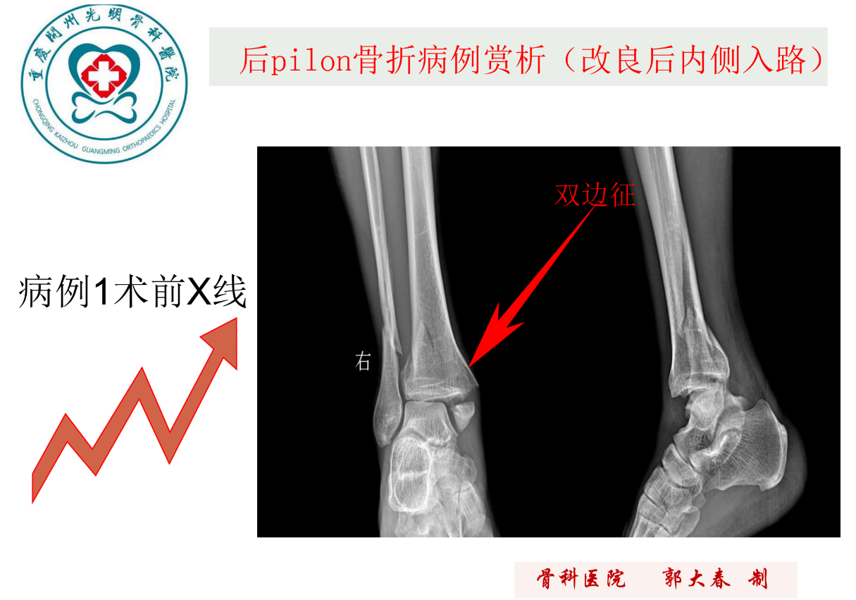 关于后pilon骨折的治疗策略，看这篇就够了！