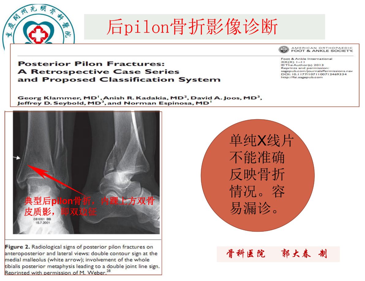 关于后pilon骨折的治疗策略，看这篇就够了！