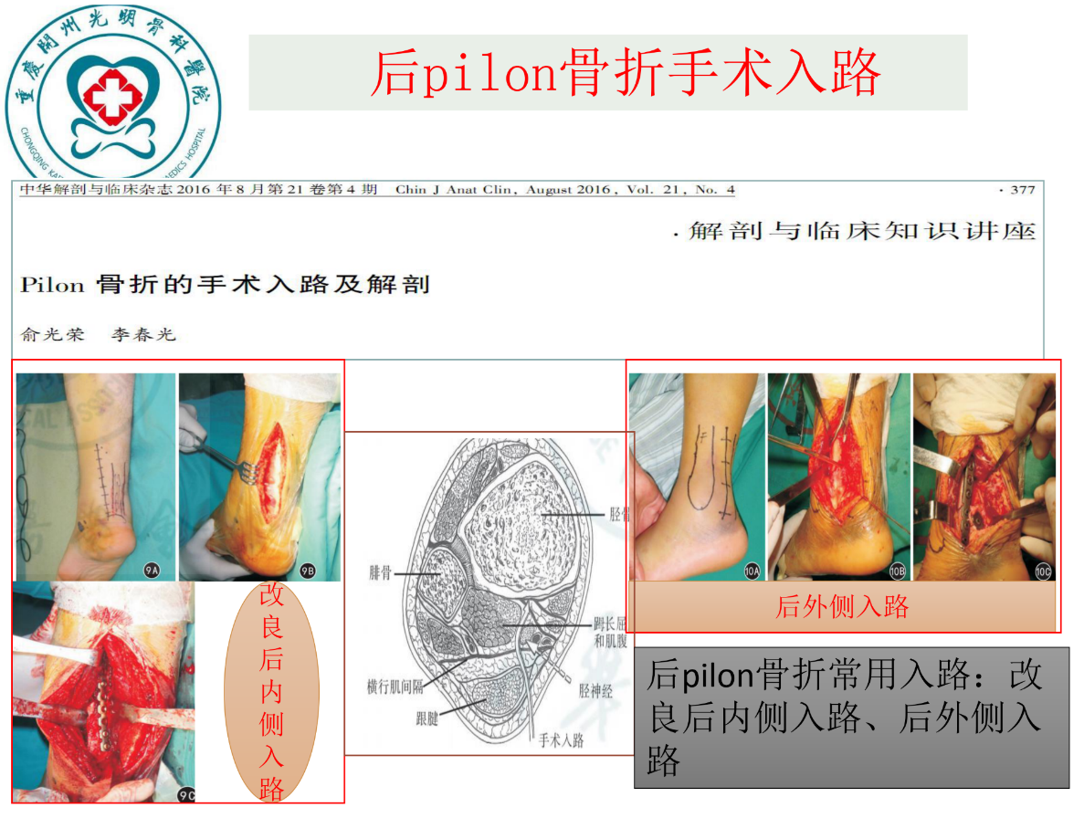 关于后pilon骨折的治疗策略，看这篇就够了！