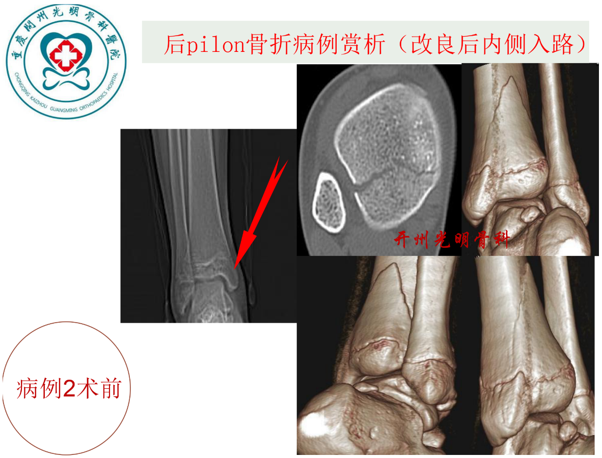 关于后pilon骨折的治疗策略，看这篇就够了！