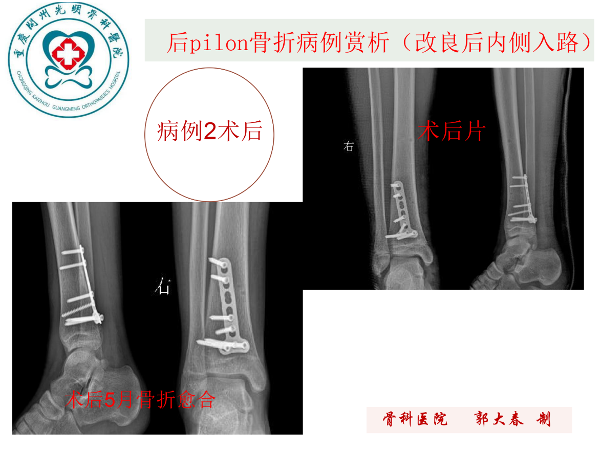 关于后pilon骨折的治疗策略，看这篇就够了！