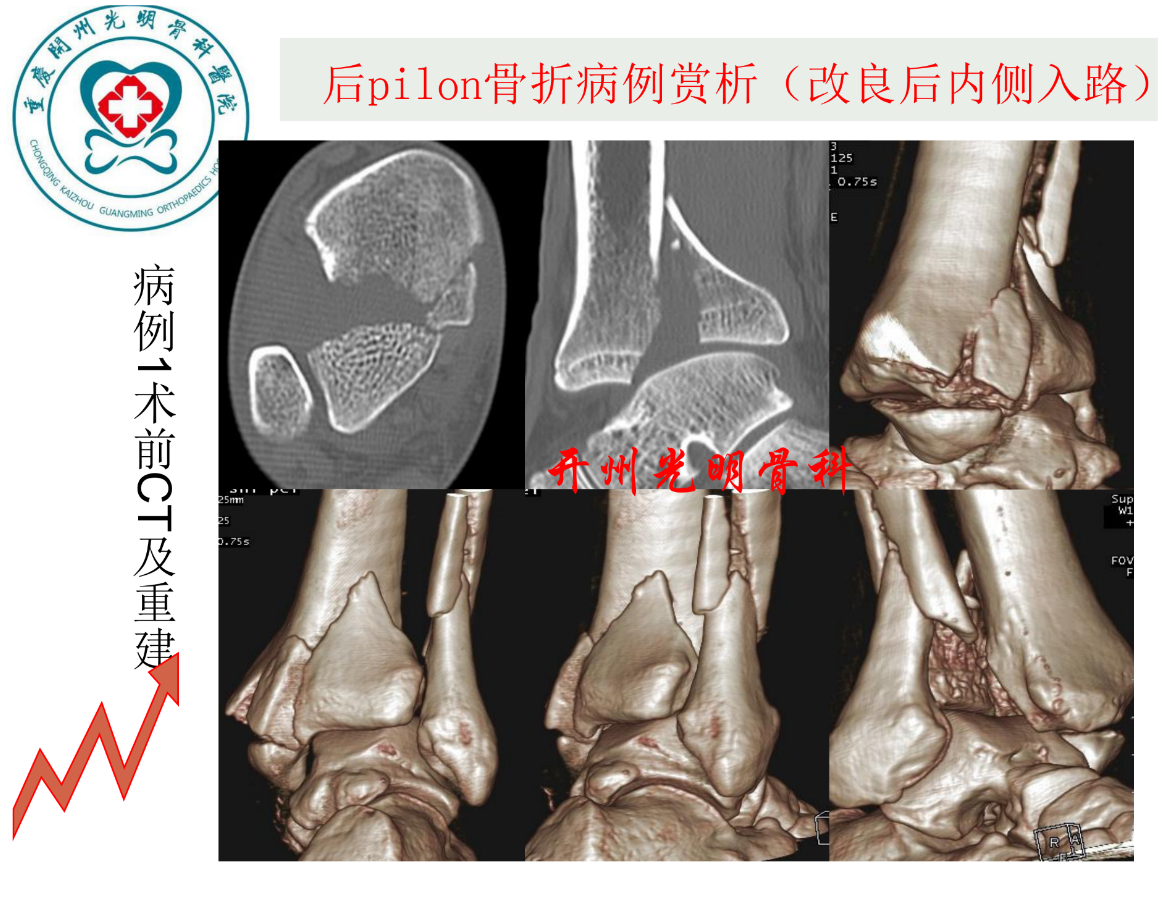 关于后pilon骨折的治疗策略，看这篇就够了！