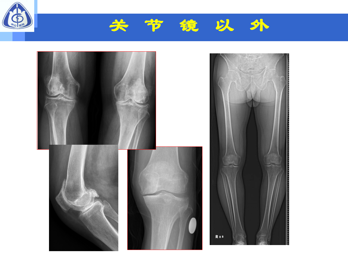 骨性关节炎的手术治疗策略，都在这篇课件里！