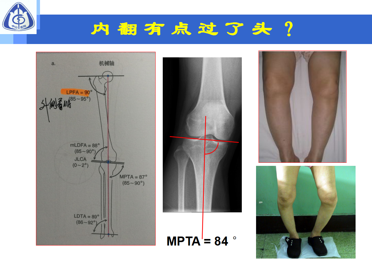 骨性关节炎的手术治疗策略，都在这篇课件里！