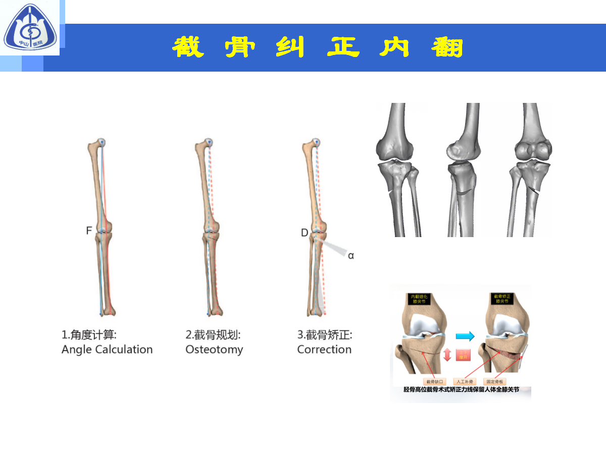 骨性关节炎的手术治疗策略，都在这篇课件里！