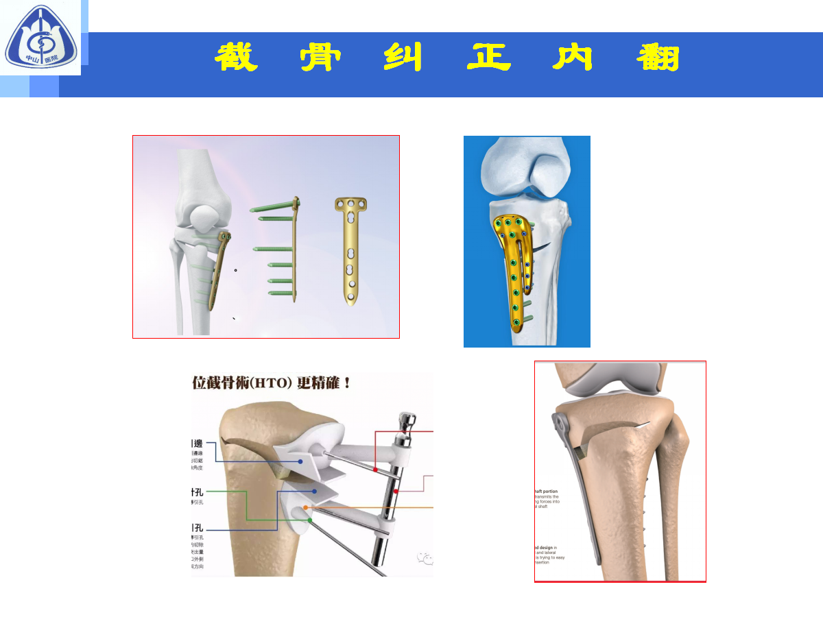 骨性关节炎的手术治疗策略，都在这篇课件里！