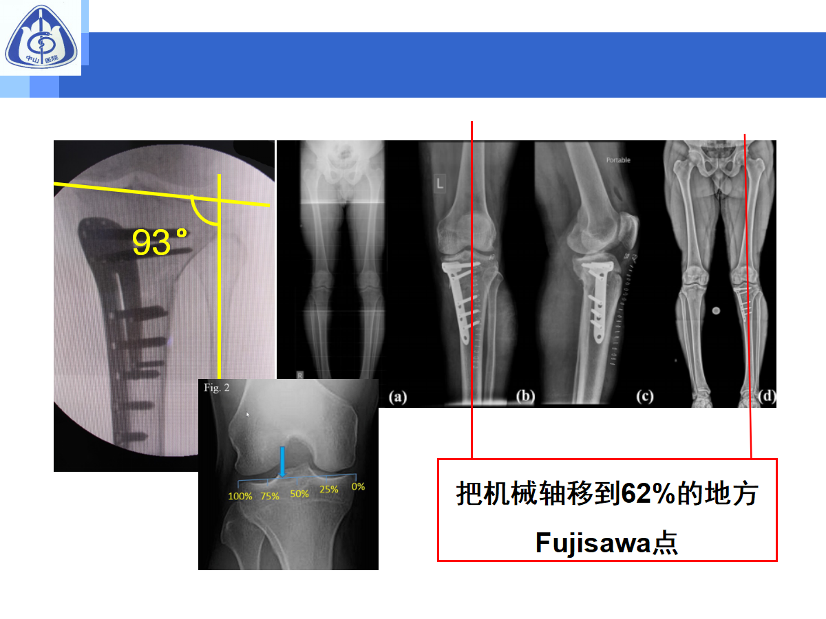 骨性关节炎的手术治疗策略，都在这篇课件里！