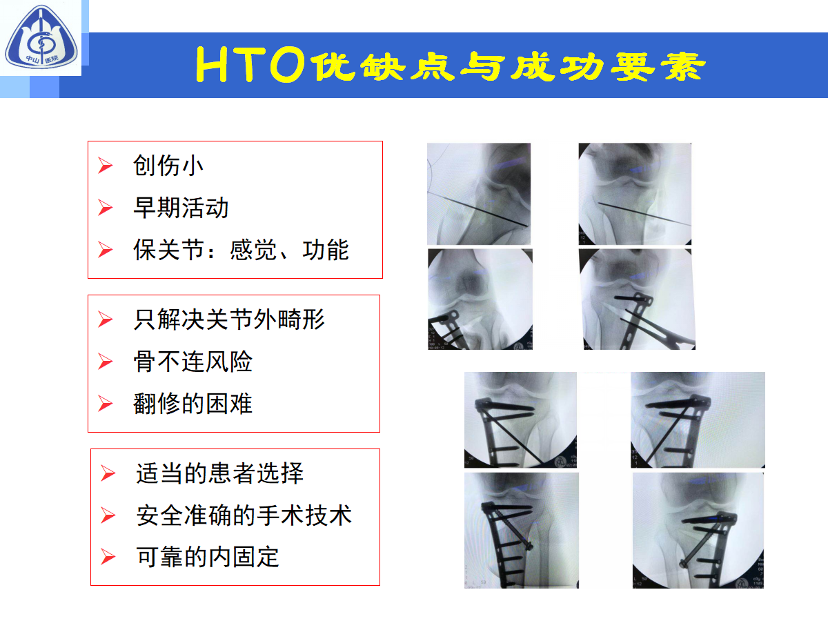 骨性关节炎的手术治疗策略，都在这篇课件里！