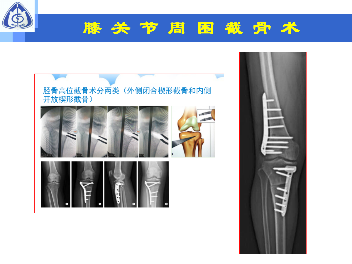 骨性关节炎的手术治疗策略，都在这篇课件里！