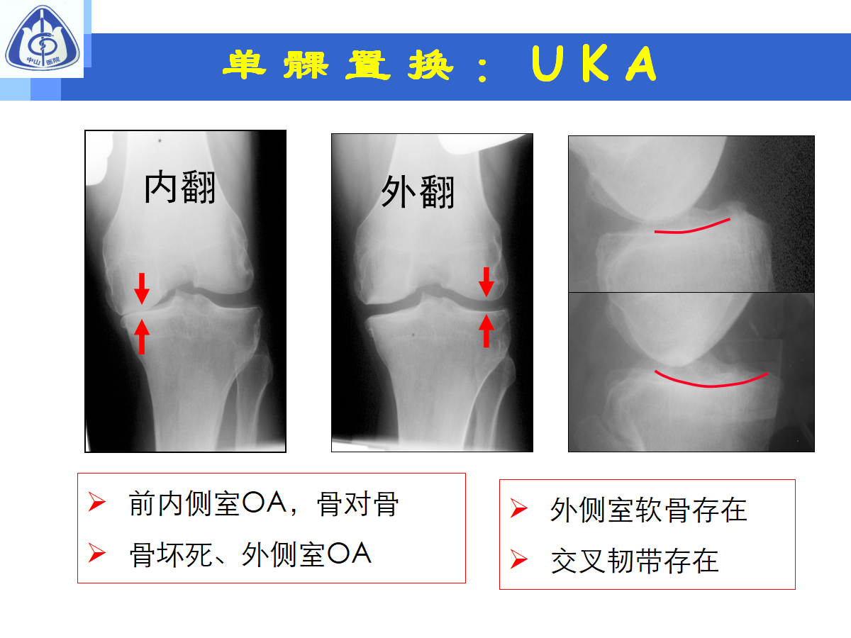 骨性关节炎的手术治疗策略，都在这篇课件里！