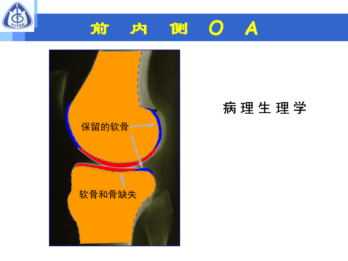 骨性关节炎的手术治疗策略，都在这篇课件里！