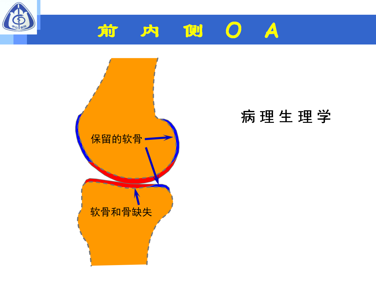 骨性关节炎的手术治疗策略，都在这篇课件里！