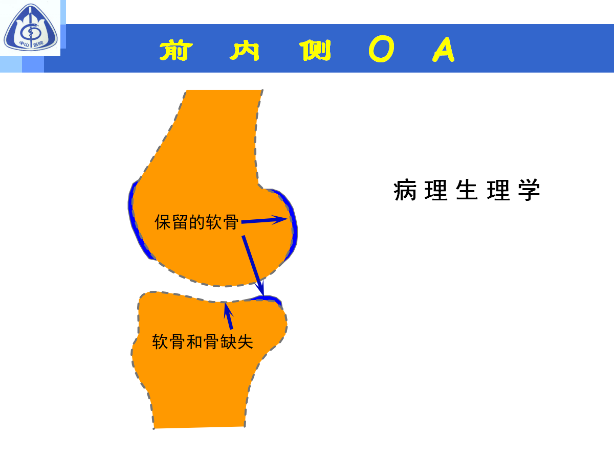 骨性关节炎的手术治疗策略，都在这篇课件里！