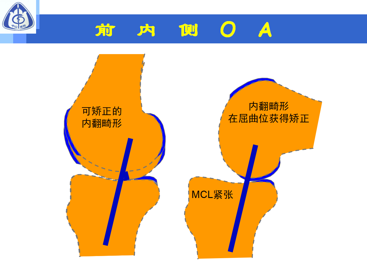 骨性关节炎的手术治疗策略，都在这篇课件里！