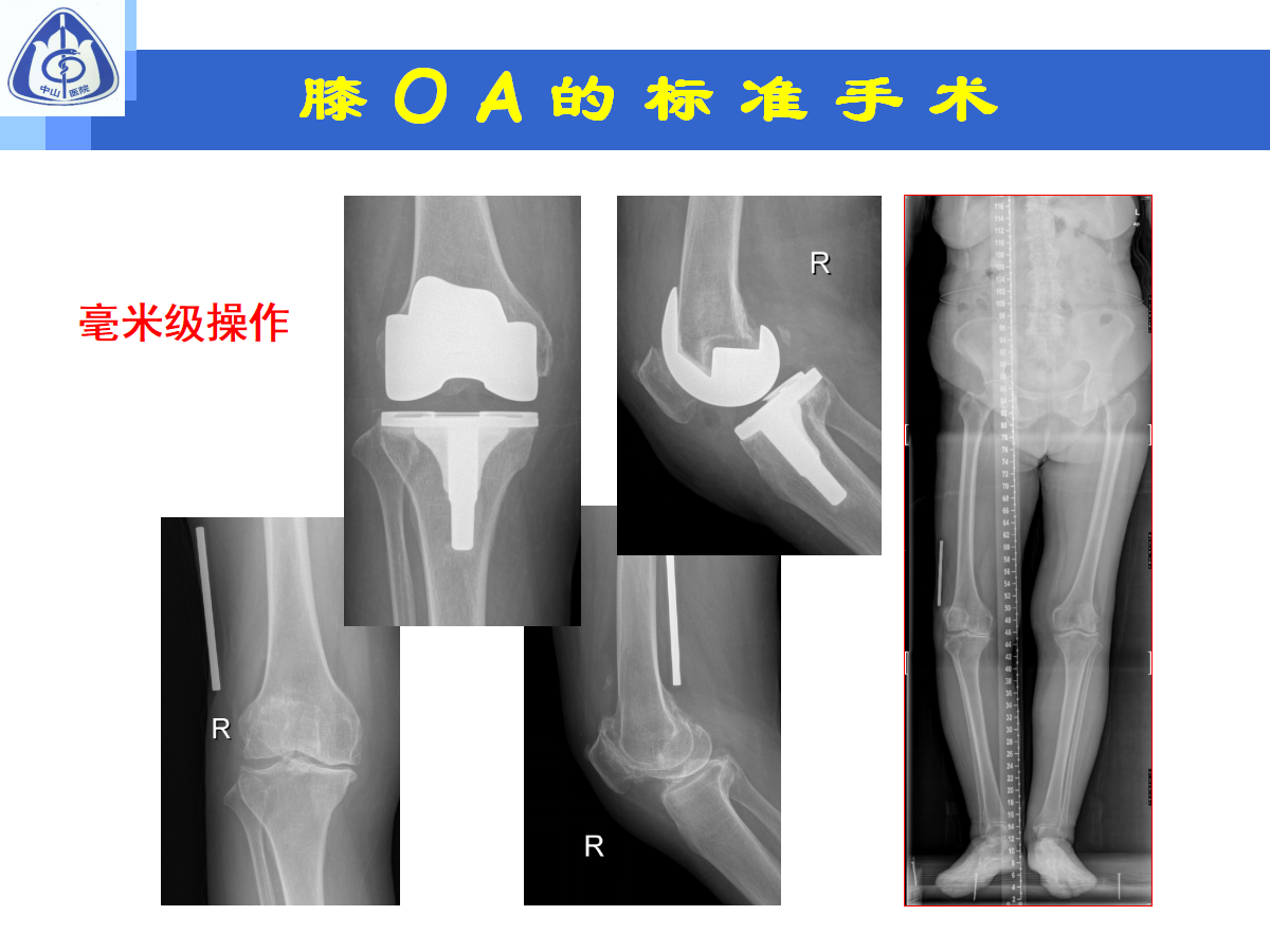 骨性关节炎的手术治疗策略，都在这篇课件里！