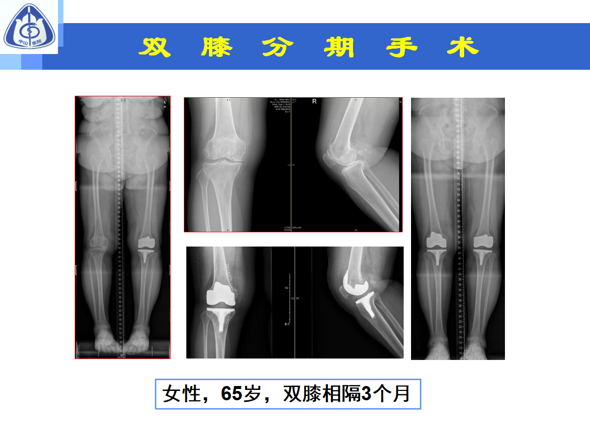 骨性关节炎的手术治疗策略，都在这篇课件里！