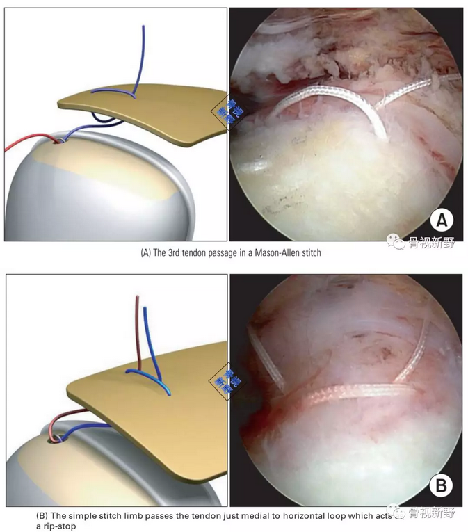 图解：改良的Mason-Allen桥式缝合技术