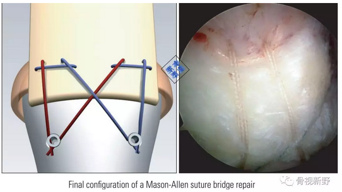 图解：改良的Mason-Allen桥式缝合技术