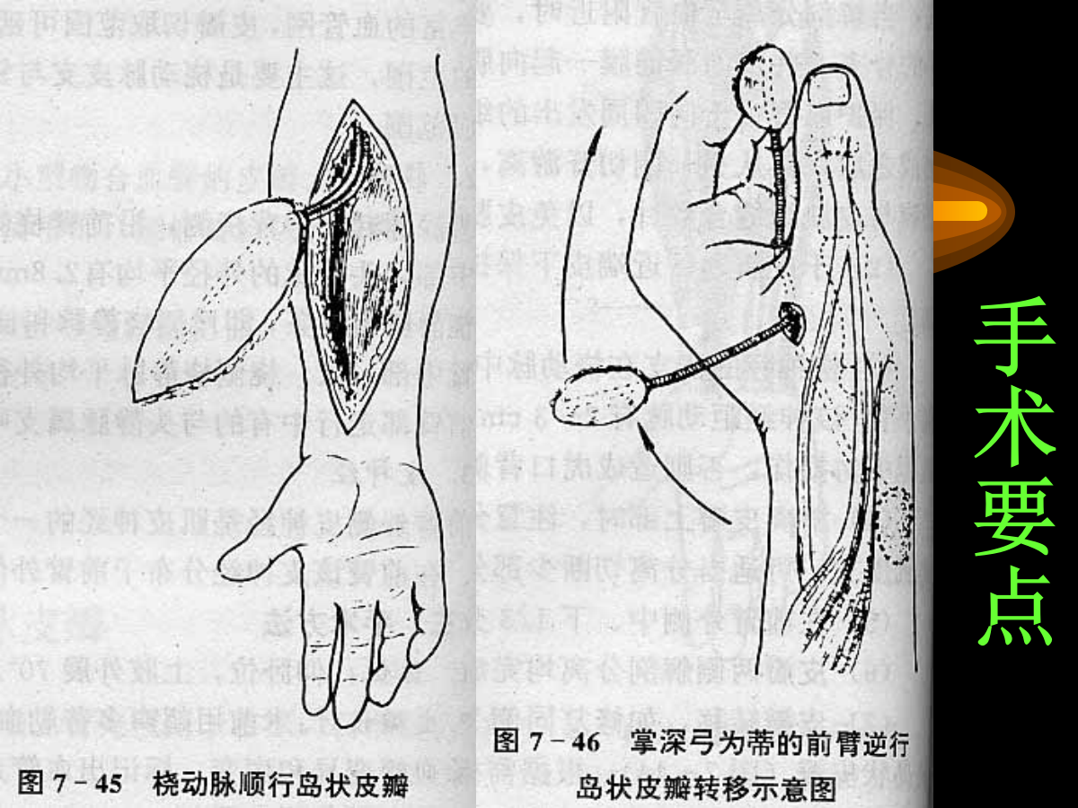 系统详解：骨科常用游离肌皮瓣及皮瓣！