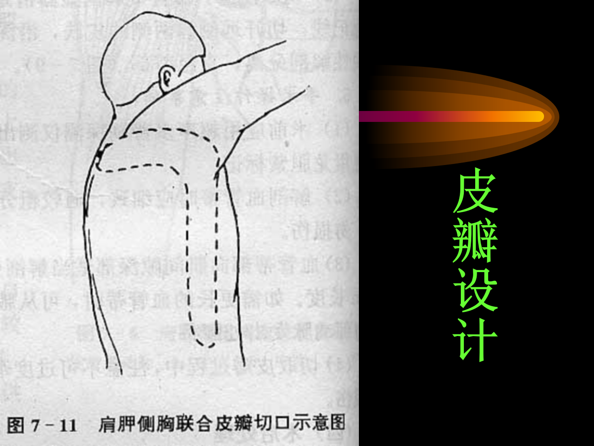 系统详解：骨科常用游离肌皮瓣及皮瓣！