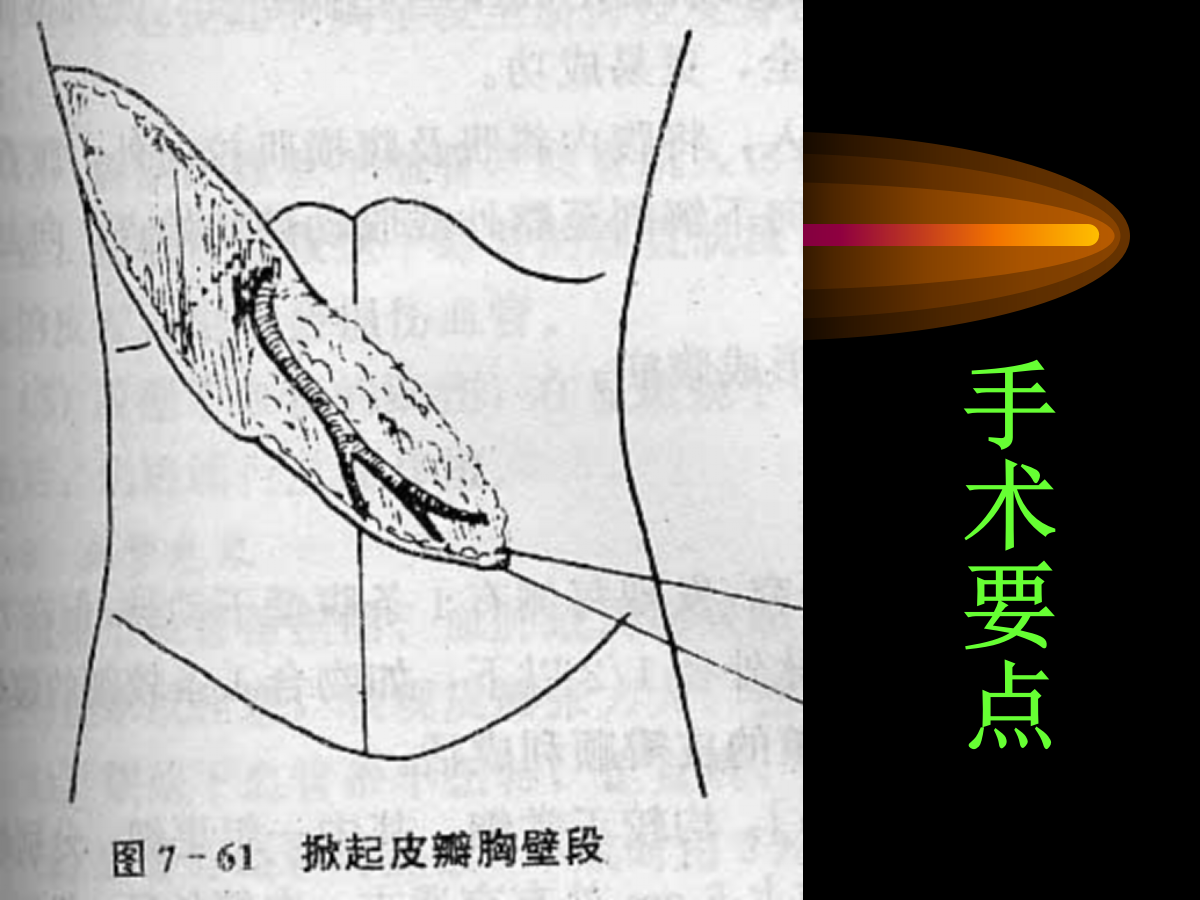 系统详解：骨科常用游离肌皮瓣及皮瓣！