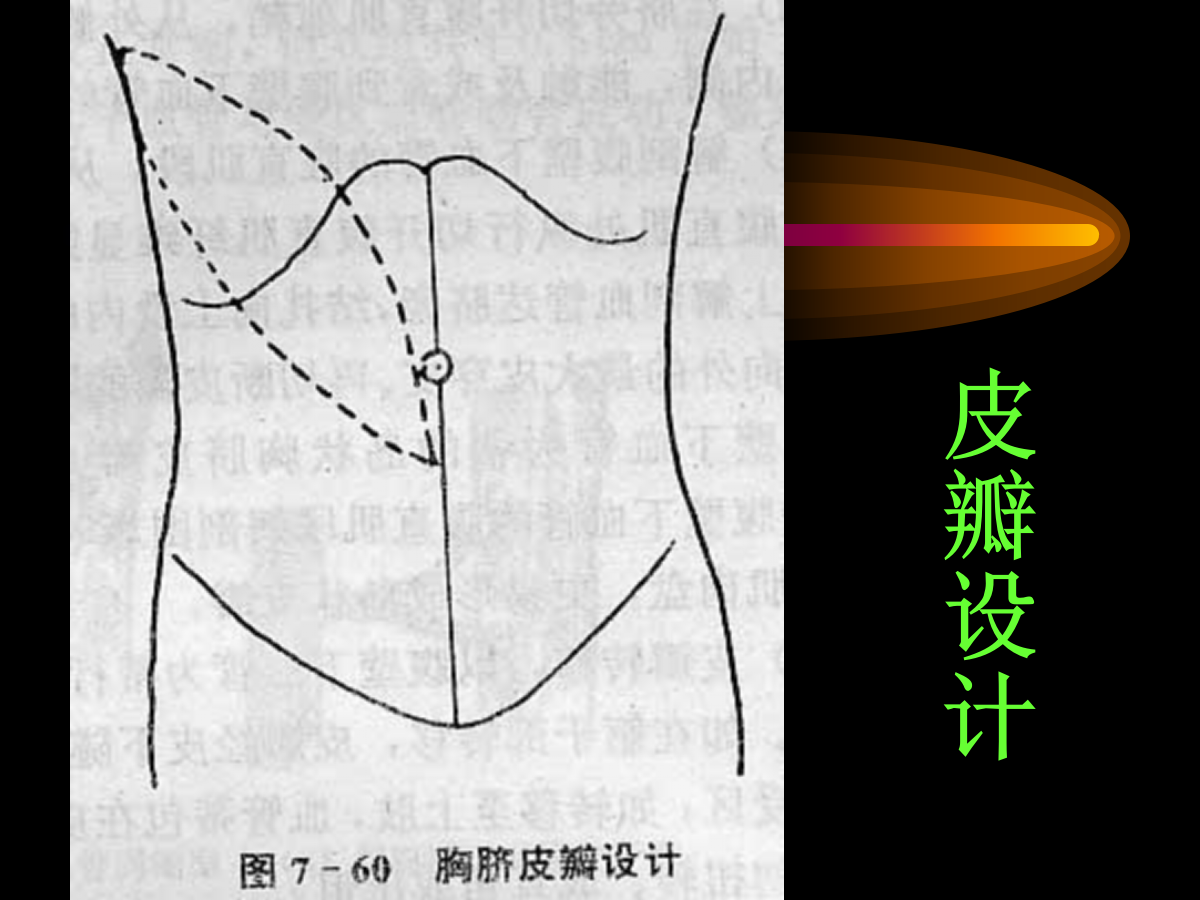 系统详解：骨科常用游离肌皮瓣及皮瓣！