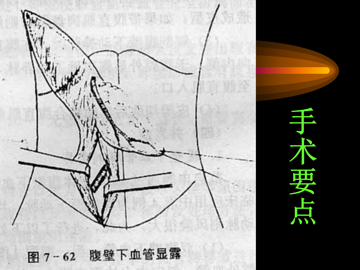 系统详解：骨科常用游离肌皮瓣及皮瓣！