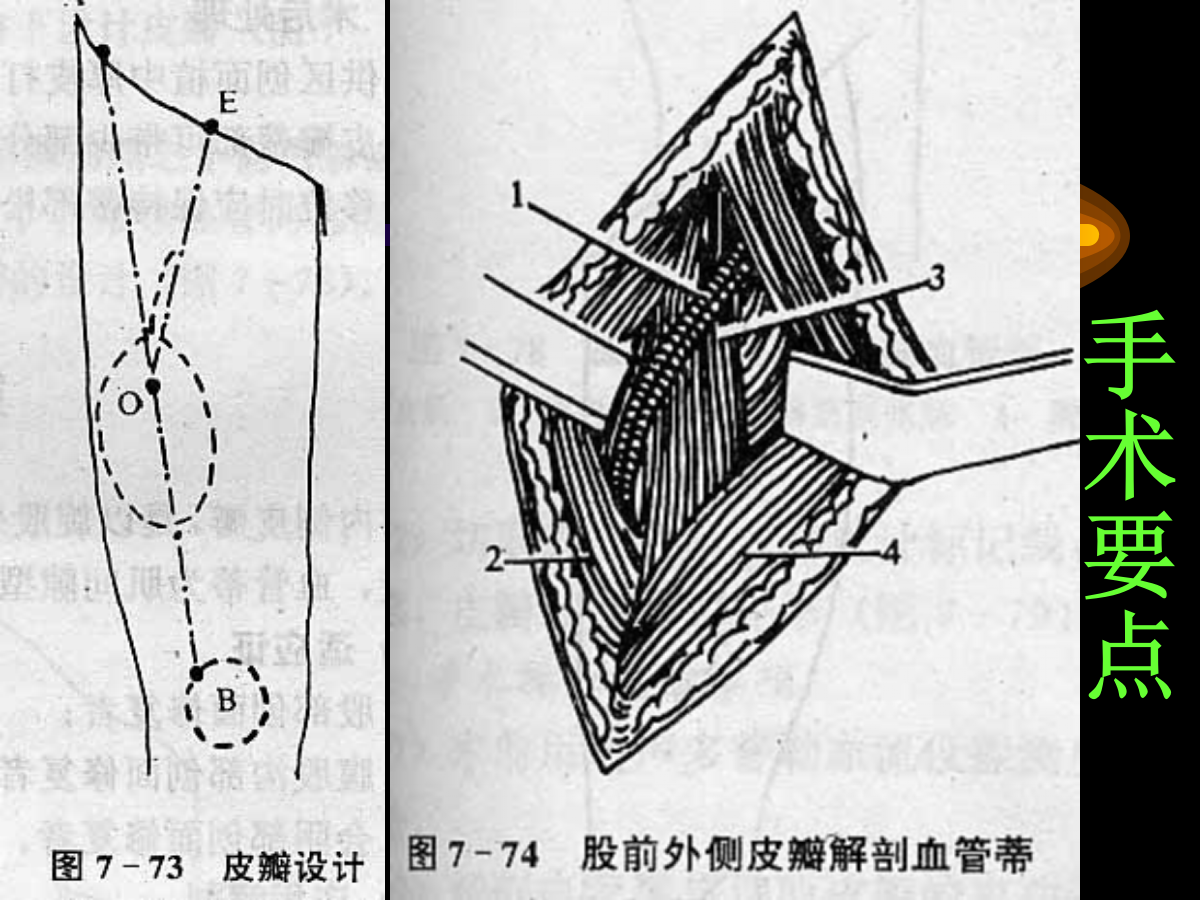 系统详解：骨科常用游离肌皮瓣及皮瓣！