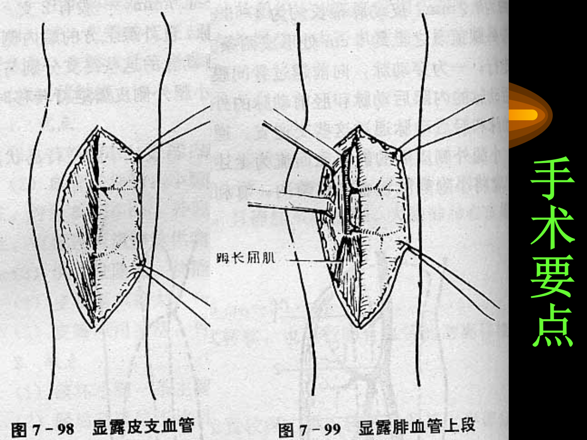 系统详解：骨科常用游离肌皮瓣及皮瓣！